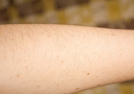 Bai thuoc tri bong, tri mun khong ngo tu tro bep - Anh 4