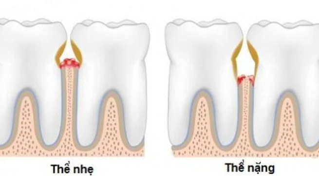 Viêm lợi có thể biến chứng viêm phổi