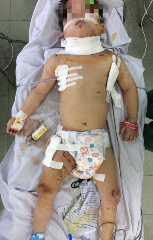 Bé trai bị chó cắn phải nhập viện Bé trai bị chó cắn phải nhập viện