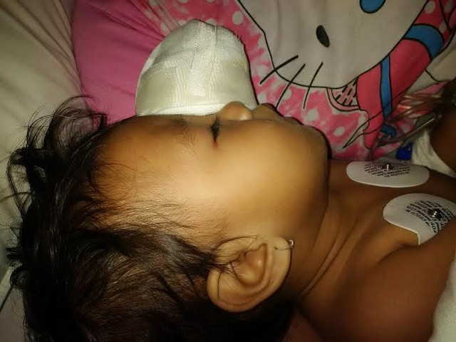 Bệnh nhi được điều trị toàn diện để bảo tồn mắt phải và có thể lắp mắt trái giả nếu có điều kiện Bệnh nhi được điều trị toàn diện để bảo tồn mắt phải và có thể lắp mắt trái giả nếu có điều kiện