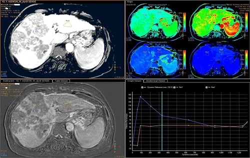 Ung thư gan được phát hiện sớm nhờ MRI Primovist. Ảnh: MD.
