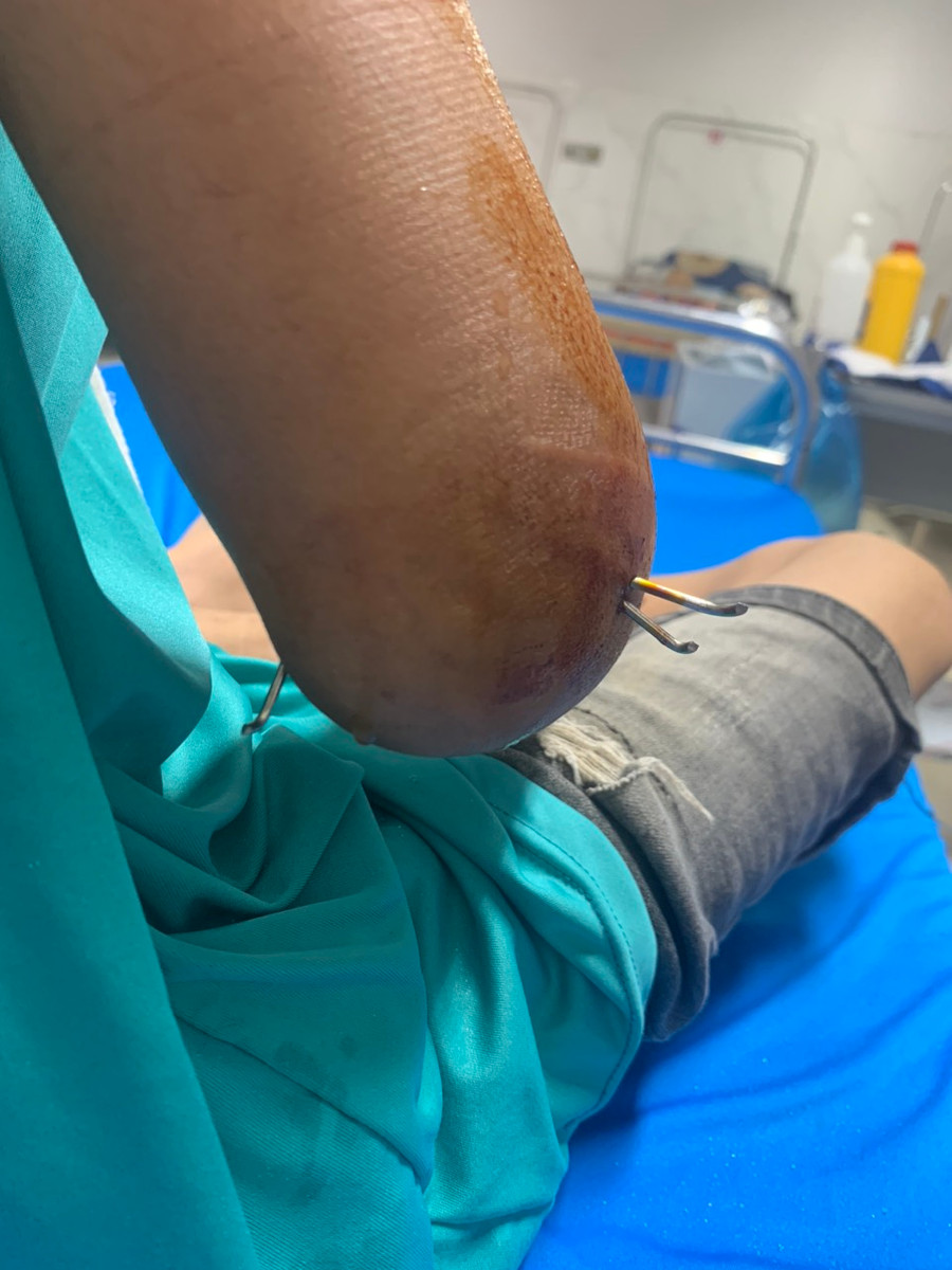 Em N. được Bệnh viện Đa khoa vùng Tây Nguyên phẫu thuật lần 1. (Ảnh: TT)