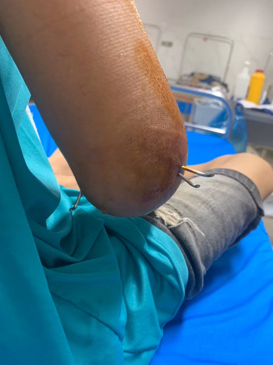 Em N. được Bệnh viện Đa khoa vùng Tây Nguyên phẫu thuật lần 1. (Ảnh: TT)