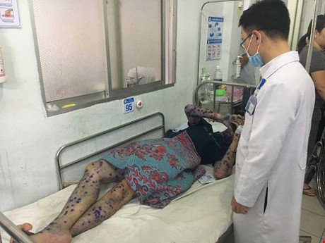Cách phòng bệnh thủy đậu - Ảnh 1 Cach phong benh thuy dau - Anh 1