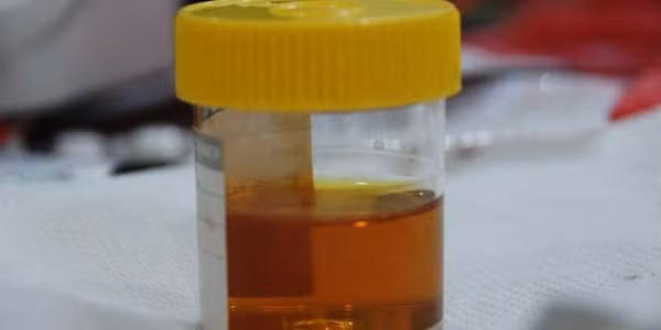 Nước tiểu vàng đậm có phải mắc bệnh gan?