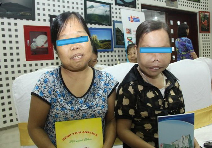 Chị Phạm Thị Vân (bên phải) hơn 24 tuổi nhưng nhìn chị thấp, bé như đứa trẻ lớp 1 Chị Phạm Thị Vân (bên phải) hơn 24 tuổi nhưng nhìn chị thấp, bé như đứa trẻ lớp 1