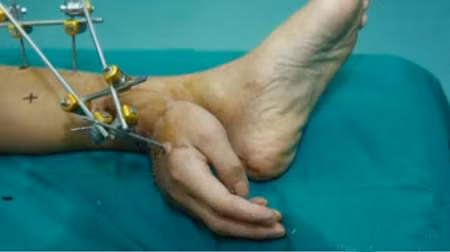 Ghép tay phải vào chân trái để cứu bàn tay