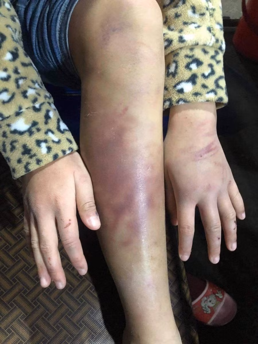 Nhiều năm qua, B. thường bị mẹ đẻ đánh đập dã man. Ảnh: Dân Việt