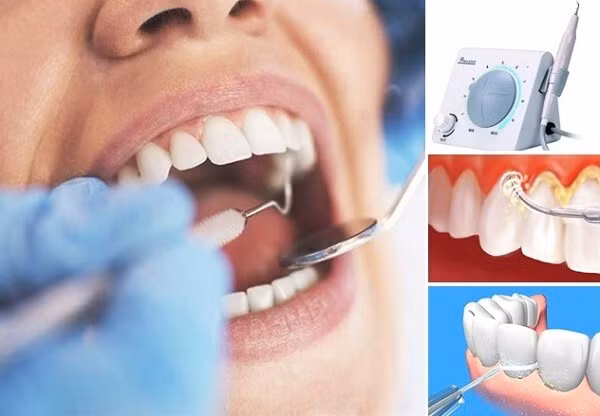 Cần đi lấy cao răng tại phòng khám hoặc bệnh viện