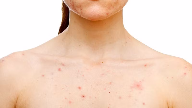 Da mẩn ngứa nổi nhiều mụn là dấu hiệu cần uống thuốc mát gan giải độc ngay