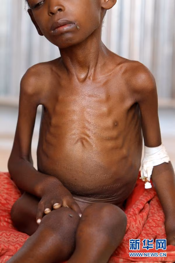 7. Nạn đói tại Sừng châu Phi. Sừng châu Phi dường như là một trong những vùng bất ổn dai dẳng nhất thế giới với những cuộc nổi dậy, chủ nghĩa cực đoan của đạo Hồi và sự yếu ớt của chính quyền Somali ở Mogadishu. Tình hình càng trở nên tồi tệ hơn vào năm nay do trận hạn hán được cho là tồi tệ nhất trong 60 năm. Vào tháng 7, Liên hợp quốc đã tuyên bố tình trạng nạn đói ở hầu hết phía nam Somalia. Hàng trăm ngàn người Somali đói khổ đã chạy tới các trại tị nạn ở biên giới Kenya. Liên hợp quốc đánh giá số người thiệt mạng do nạn đói này có thể vào khoảng hàng chục ngàn người.