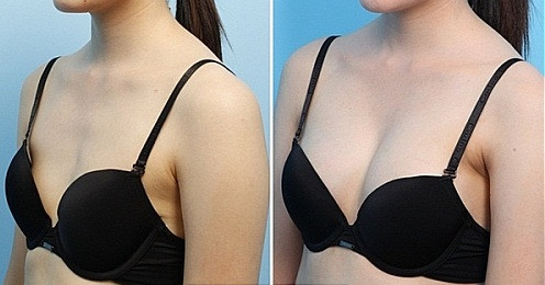 Vận động quá mạnh là nguyên nhân khiến ngực nhỏ đi