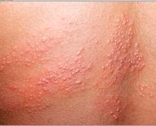 Zona thần kinh: Càng căng thẳng càng đau đớn