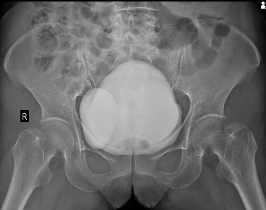 Hình ảnh chụp CT cho thấy bệnh nhân có túi thừa bàng quang.