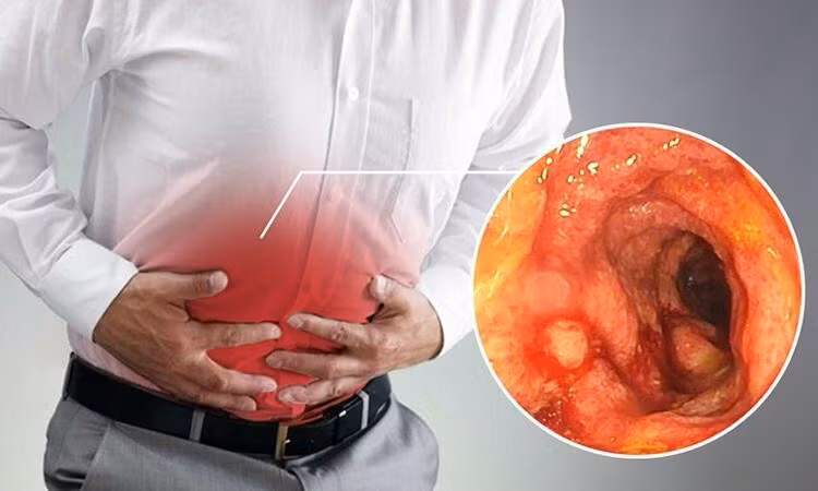 Viêm đại tràng mãn tính có thể gây loét, áp xe, thủng đại tràng