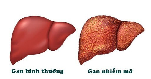 Gan nhiễm mỡ được xác định khi 5% trọng lượng là chất béo Gan nhiễm mỡ được xác định khi 5% trọng lượng là chất béo