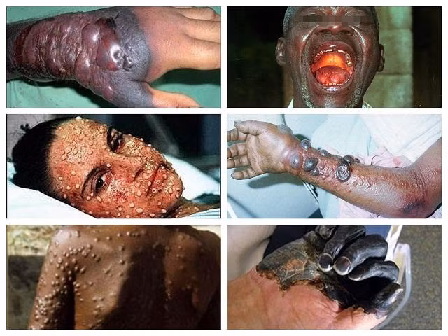 Đại dịch nguy hiểm cả thế giới Ebola