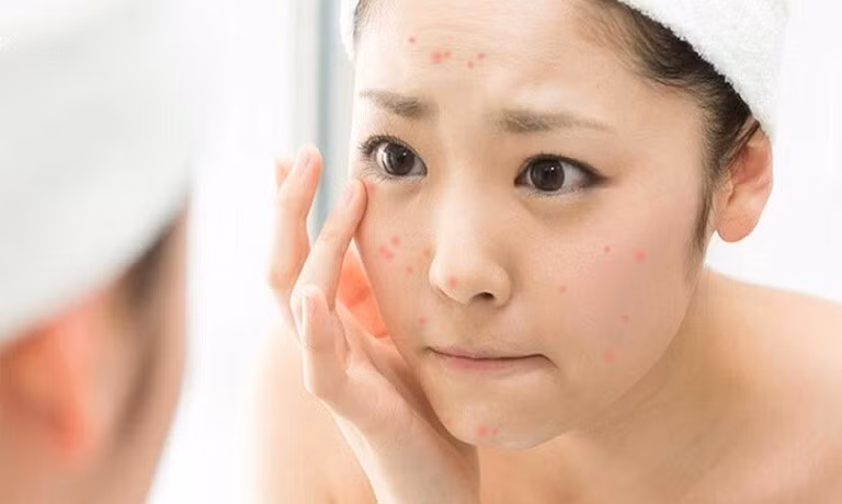 Rửa mặt không sạch là nguyên nhân gây mụn trứng cá