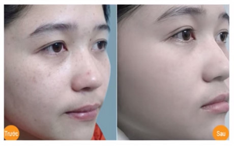 Không phải tốn tiền đến spa nữa, bạn có thể tự làm “thần dược” trị nám da ngay tại nhà - Ảnh 6 Khong phai ton tien den spa nua, ban co the tu lam “than duoc” tri nam da ngay tai nha - Anh 6