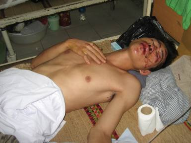 Nạn nhân Nguyễn Hữu Cự sau khi được đưa vào viện cấp cứu