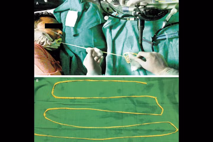 Kinh hãi cảnh sán dây dài gần 1,9m được đưa ra khỏi miệng bệnh nhân