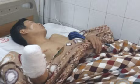 Cut tay, mu mat do dot phao - Anh 1