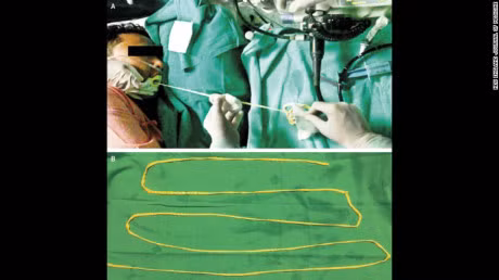 Kinh hai canh san day dai gan 1,9m duoc dua ra khoi mieng benh nhan - Anh 1