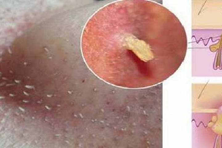 Mụn đầu đen ở mũi tự khắc chui ra nhờ hỗn hợp này