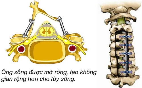 
Trong phẫu thuật điều trị hẹp ống sống cổ do thoái hóa, bác sĩ sẽ mở rộngống sống, tạo không gian thoánghơn cho tủy sống, giải phóngtình trạng chèn ép.