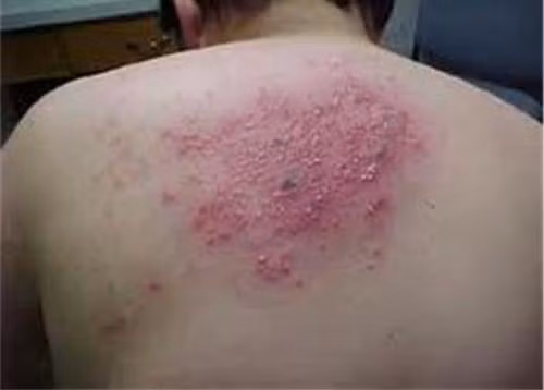 Sai lầm phổ biến trong điều trị giời leo