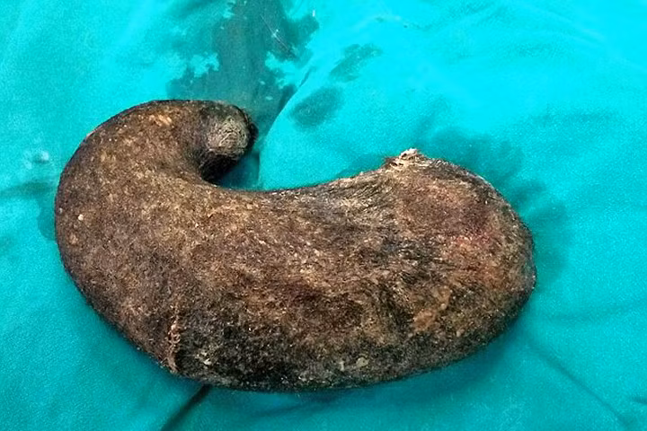 Khối tóc kết nặng hơn 1kg trong bụng bệnh nhân 15 tuổi.