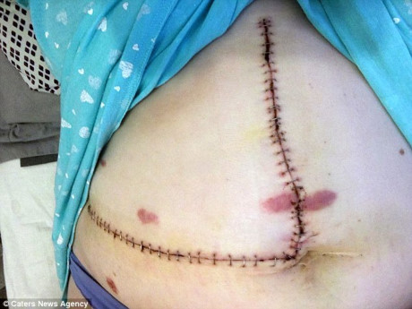 Uong thuoc tranh thai 12 nam lien tuc, thieu nu bi u gan - Anh 5