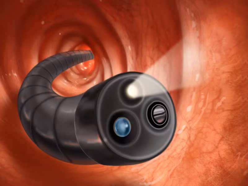 Nội soi đại tràng giúp bác sĩ xem có bị viêm loét đại tràng hay không