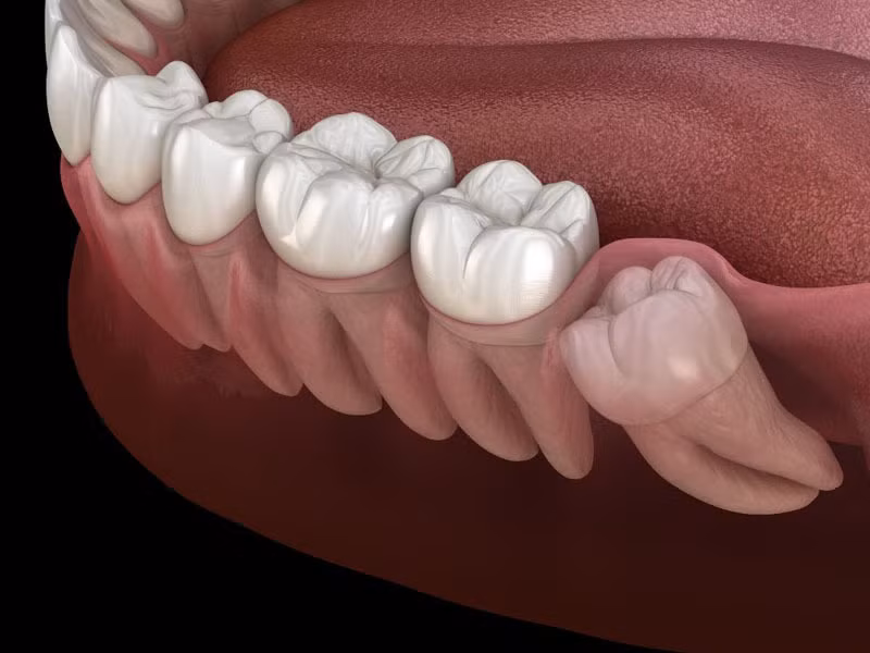 Sử dụng thuốc giảm đau sẽ giúp giảm đau nhức răng khôn