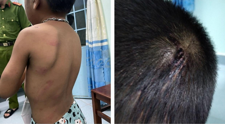 Những vết thương trên cơ thể cháu T. Những vết thương trên cơ thể cháu T.