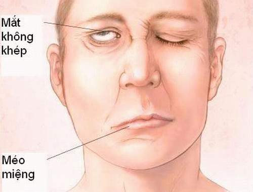 Liệt dây thần kinh số VII làm mất khả năng nhắm mắt và méo miệng có triệu chứng giống như đột quỵ liên quan đến tổn thương cầu não. Liệt dây thần kinh số VII làm mất khả năng nhắm mắt và méo miệng có triệu chứng giống như đột quỵ liên quan đến tổn thương cầu não.