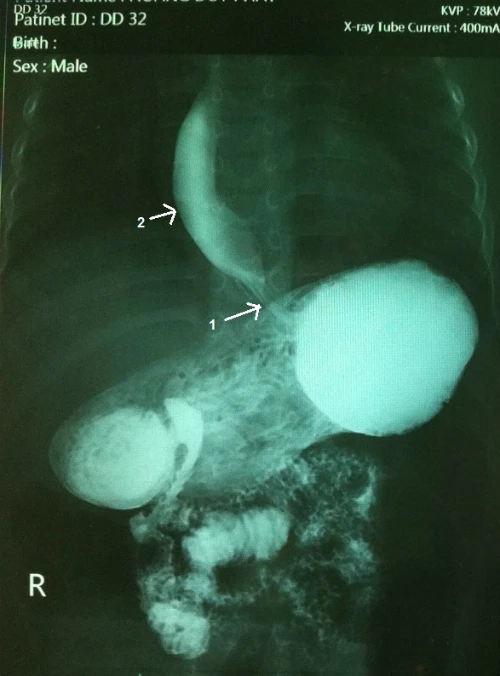 Ảnh chụp Xquang của cháu Duy cho thấy đoạn cuối của thực quản nơi đổ vào dạ dày bị co thắt và hẹp lại, đoạn trên bị giãn to ra. Ảnh: Khánh Chi.