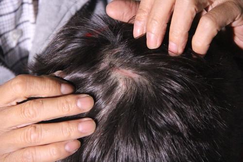 Vét sẹo trên đầu bởi trận đòn bằng guốc nhọn Vét sẹo trên đầu bởi trận đòn bằng guốc nhọn