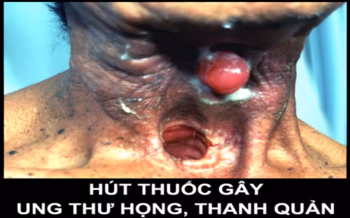 Thuốc lá nguyên nhân hàng đầu mắc bệnh hô hấp