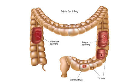 Hậu quả của viêm đại tràng mạn tính - Ảnh 1 Hau qua cua viem dai trang man tinh - Anh 1