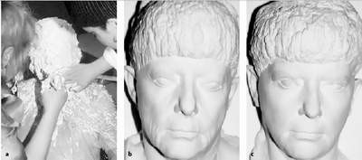 Hình a: Tạo mẫu khuôn mặt bệnh nhân bằng thạch cao để có được minh chứng trong không gian 3 chiều về những gì làm được; Hình b: Trước phẫu thuật; Hình c: Sau phẫu thuật.