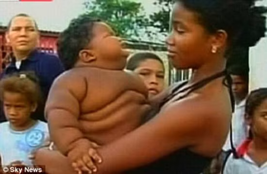 Colombia: Bé trai 8 tháng tuổi nặng... 20kg