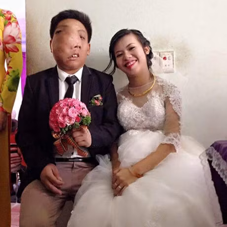 Chuyen tinh dep cua co gai 9x va chang trai co khoi u di biet - Anh 1