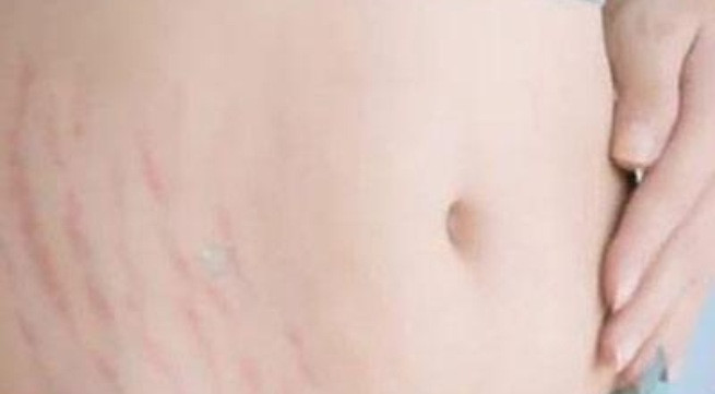 Khắc phục những vết rạn da