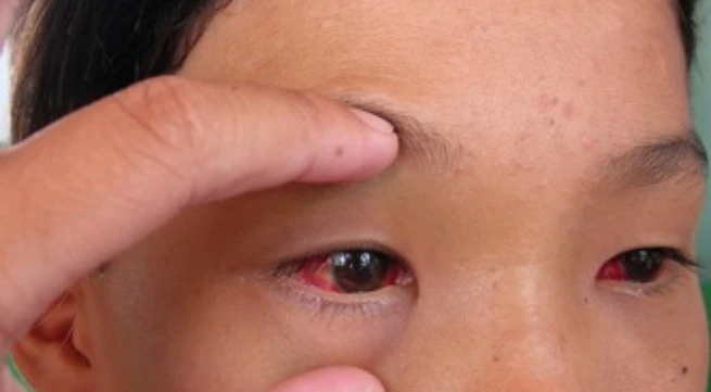 Xuất huyết dưới kết mạc có nguy hiểm?