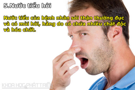 8 dấu hiệu cảnh báo bệnh sỏi thận - Ảnh 5 8 dau hieu canh bao benh soi than - Anh 5