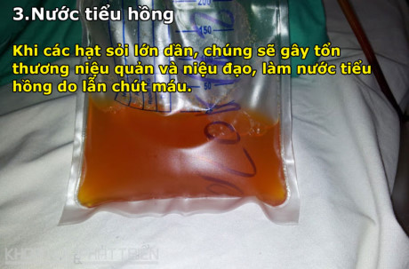8 dấu hiệu cảnh báo bệnh sỏi thận - Ảnh 3 8 dau hieu canh bao benh soi than - Anh 3