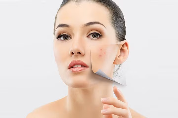 Cách bảo vệ da khi có mụn trứng cá