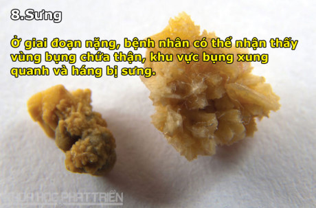 8 dấu hiệu cảnh báo bệnh sỏi thận - Ảnh 8 8 dau hieu canh bao benh soi than - Anh 8