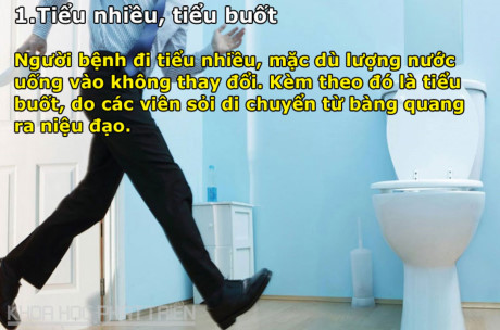 8 dấu hiệu cảnh báo bệnh sỏi thận - Ảnh 1 8 dau hieu canh bao benh soi than - Anh 1